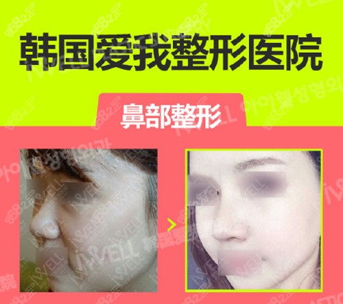 鼻翼缩小术千万别做:鼻翼缩小术,你真的需要做吗? 鼻翼缩小术千万别做:鼻翼缩小术,你真的需要做吗?