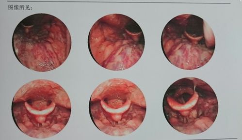 慢性咽炎在喉咙打一针:慢性咽炎在喉咙打一针?这种神奇疗法能帮你告别喉咙不适! 慢性咽炎在喉咙打一针:慢性咽炎在喉咙打一针?这种神奇疗法能帮你告别喉咙不适!