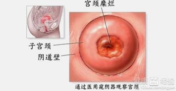 宫颈糜烂的症状有哪些:女性必看,宫颈糜烂的常见症状及应对措施 宫颈糜烂的症状有哪些:女性必看,宫颈糜烂的常见症状及应对措施