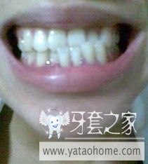 什么牙套最好最实惠：性价比最高的牙套，什么最实惠又有效？